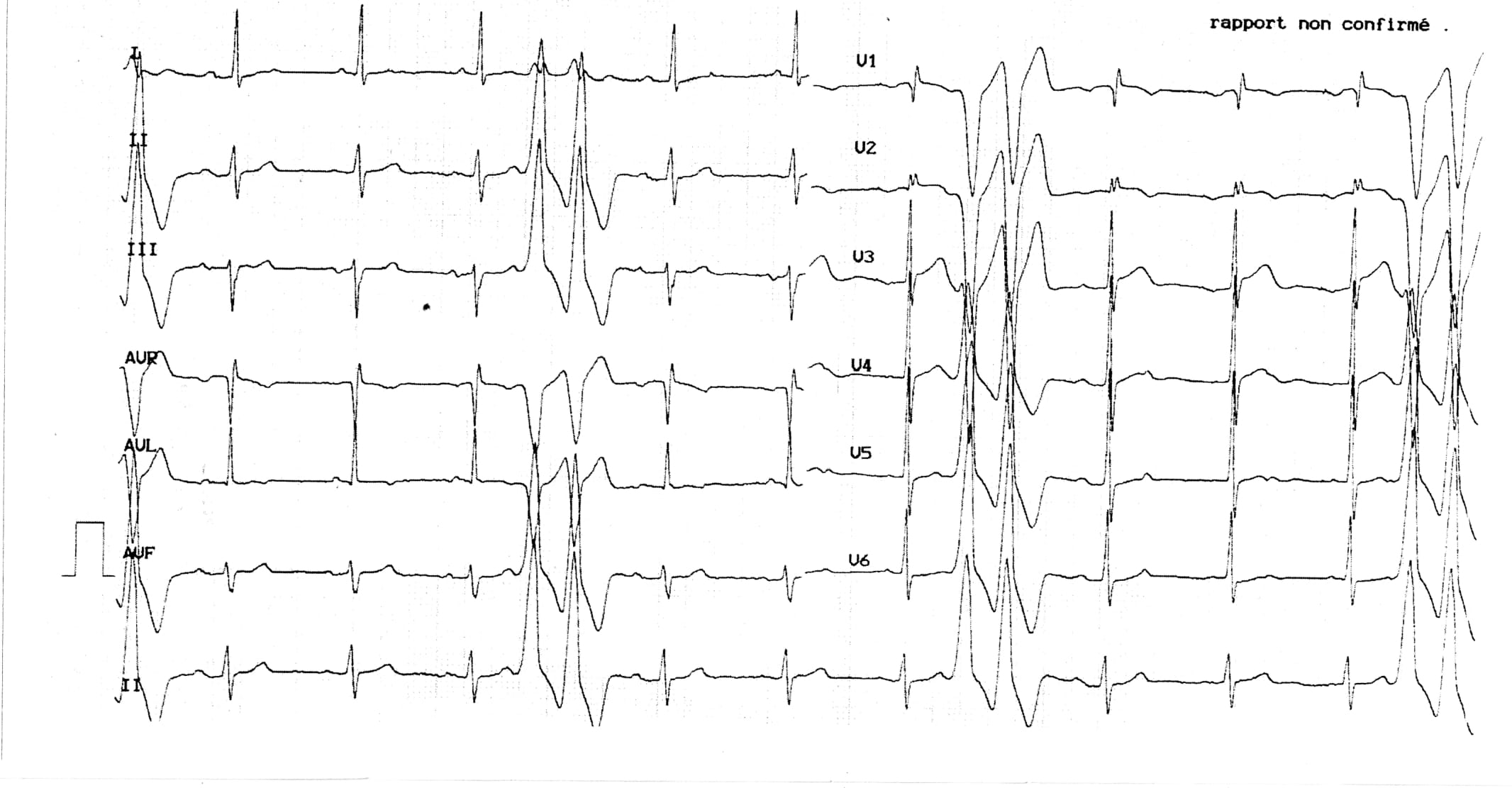 Vivre Avec Une Dysplasie Du Ventricule Droit