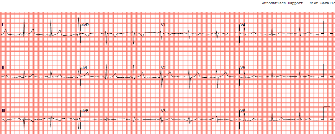 ECG beoordeling Marieke Rutjens