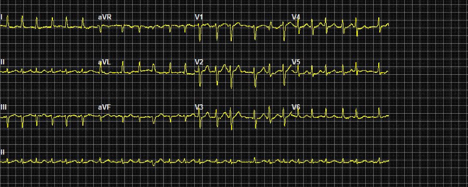ECG terugkomdag 13-1-2020