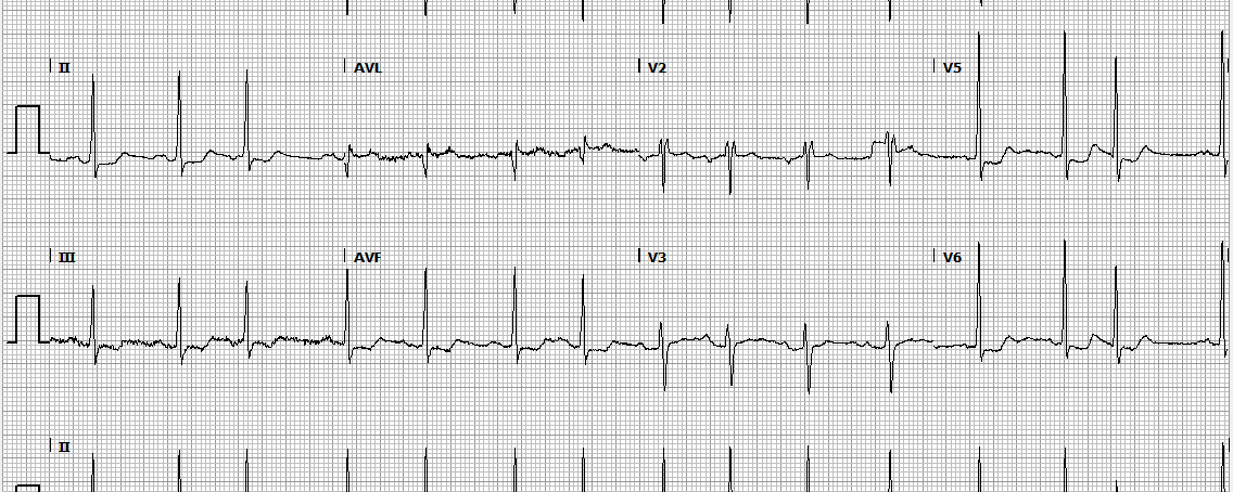 Casusomschrijving: koorts, misselijkheid en braken. Is er sprake van cardiogene shock/myocardinfarct?