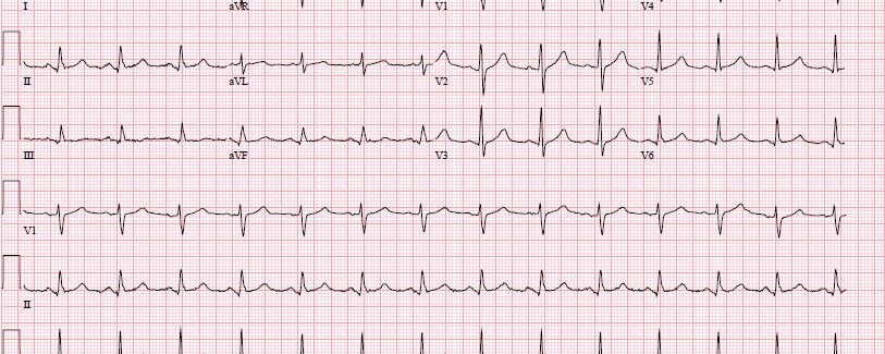 Patiënt met een sepsis met verdenking endocarditis