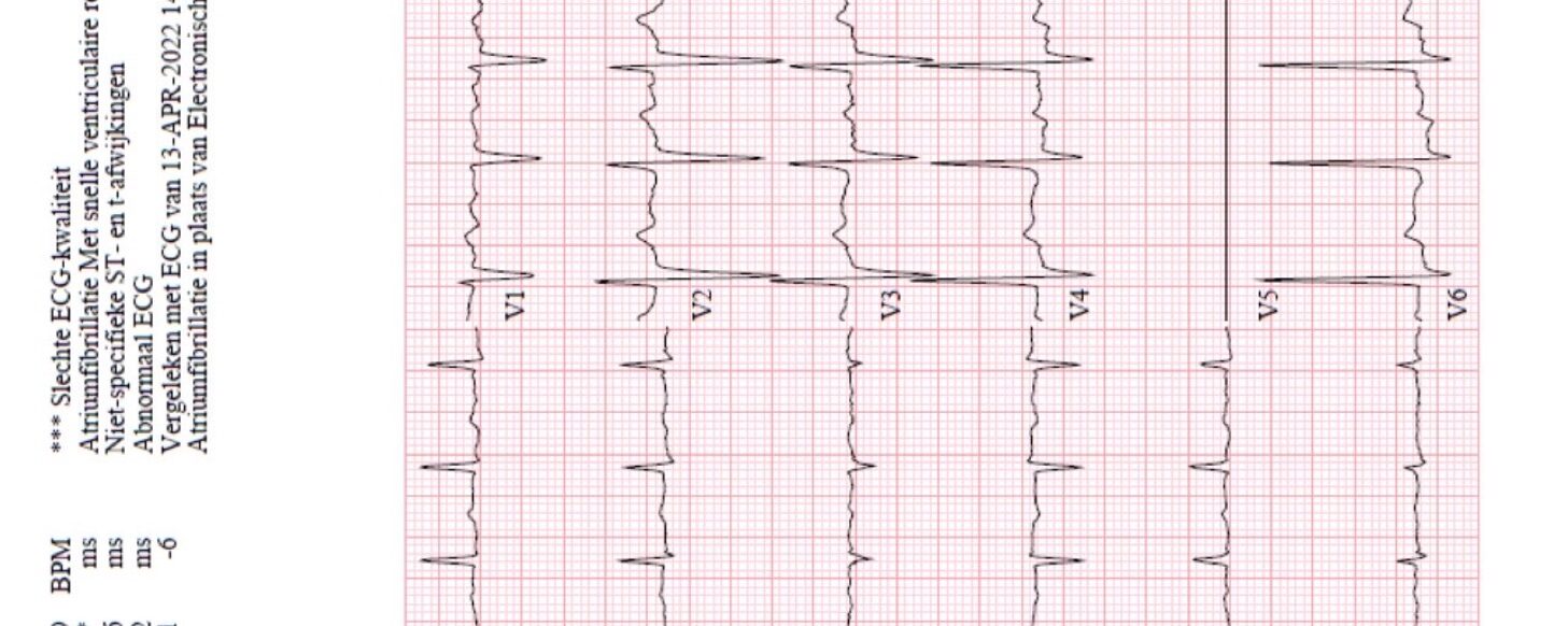 ECG opdracht Lia Bica; ECG-afwijkingen bij hyperkaliemie?