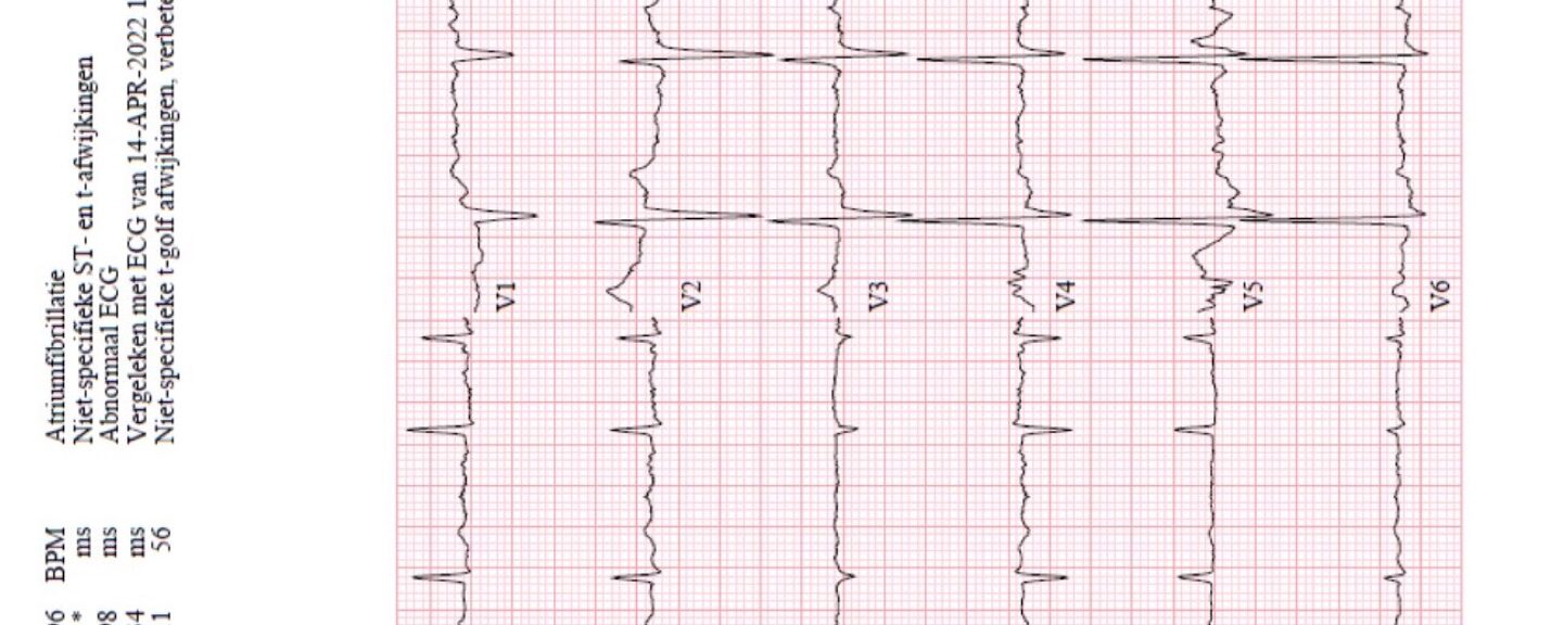 ECG opdracht Lia Bica; Afwijkingen bij hyperkaliemie?