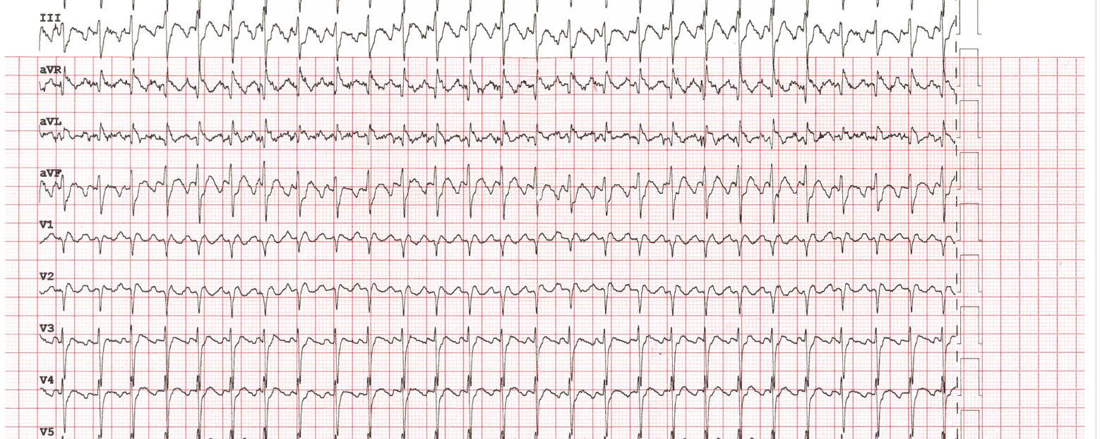 ECG interpretatie bij 76-jarige patiënte met dyspnoeklachten