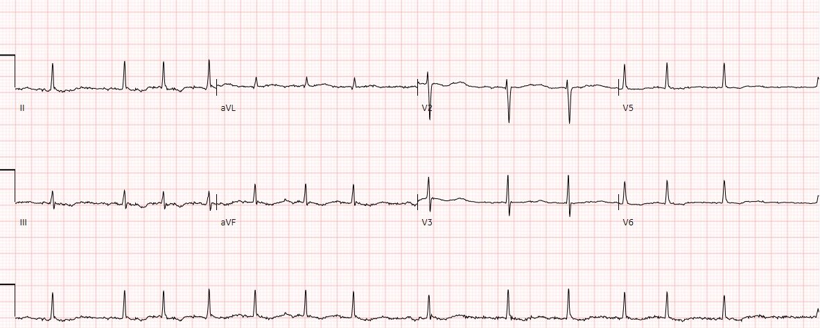 ECG Deb
