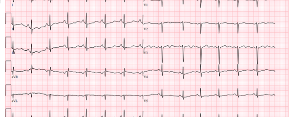 ECG bij elektrolytenstoornis