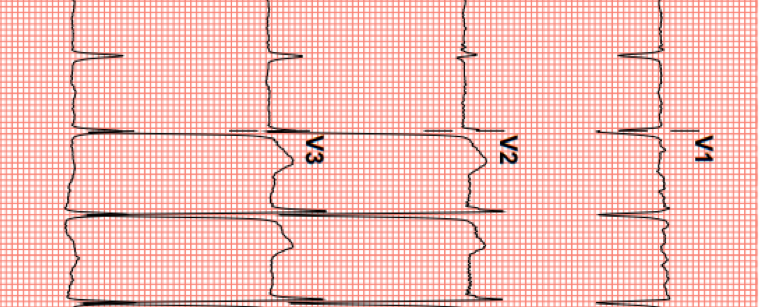 ECG terugkomdag coschap beschouwend ako