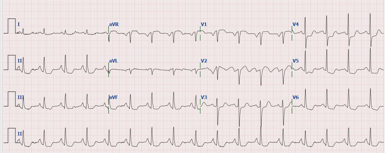 ECG opdracht Laurance