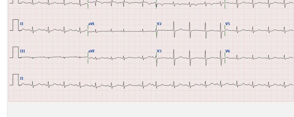 ECG 09-06-22