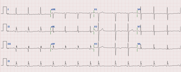 ECG van een 62-jarige man