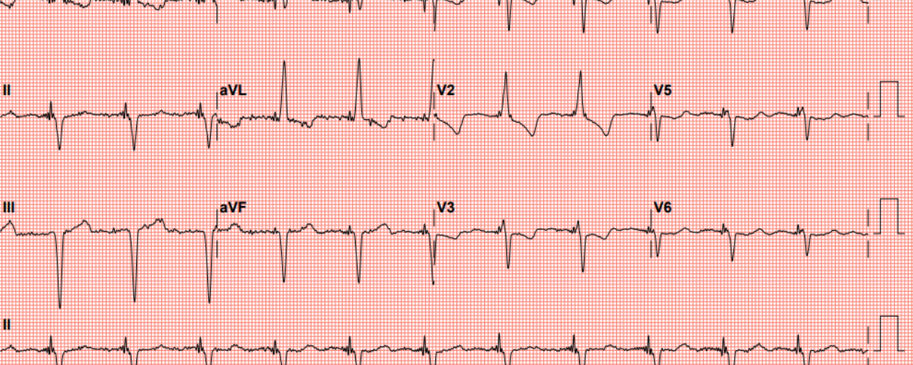 Verlengd QTc