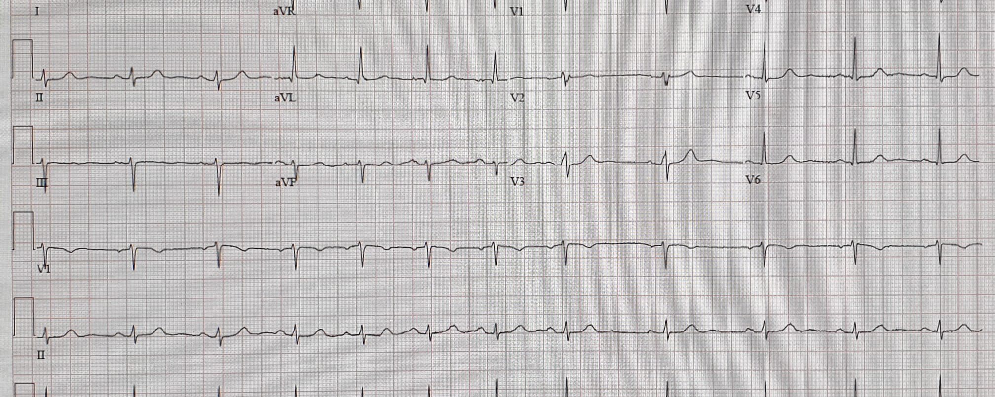 Patient frequent vallen + irregulaire hartslag