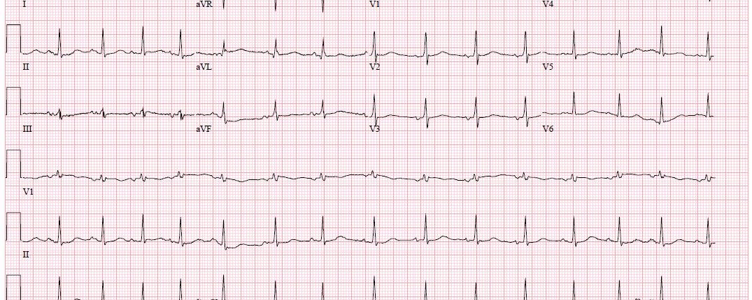 79 jarige vrouw met mogelijk sepsis wordt opgenomen op SEH