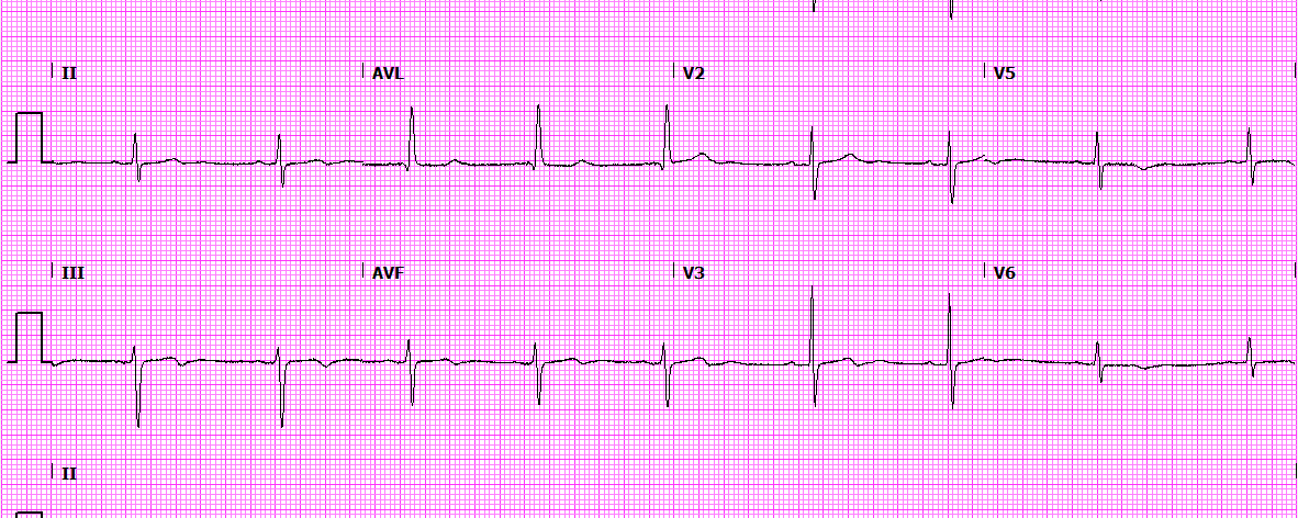Mevrouw X, syncope oorzaak?