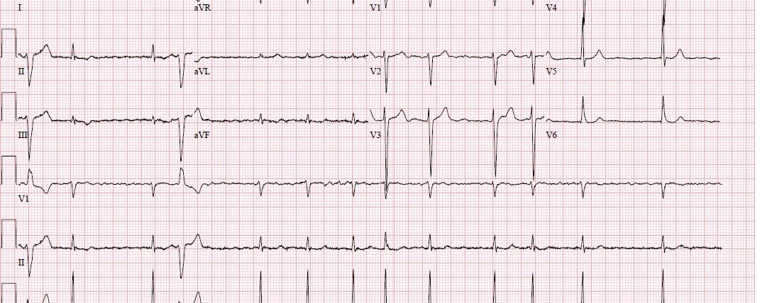 ECG Atriumfibrilleren