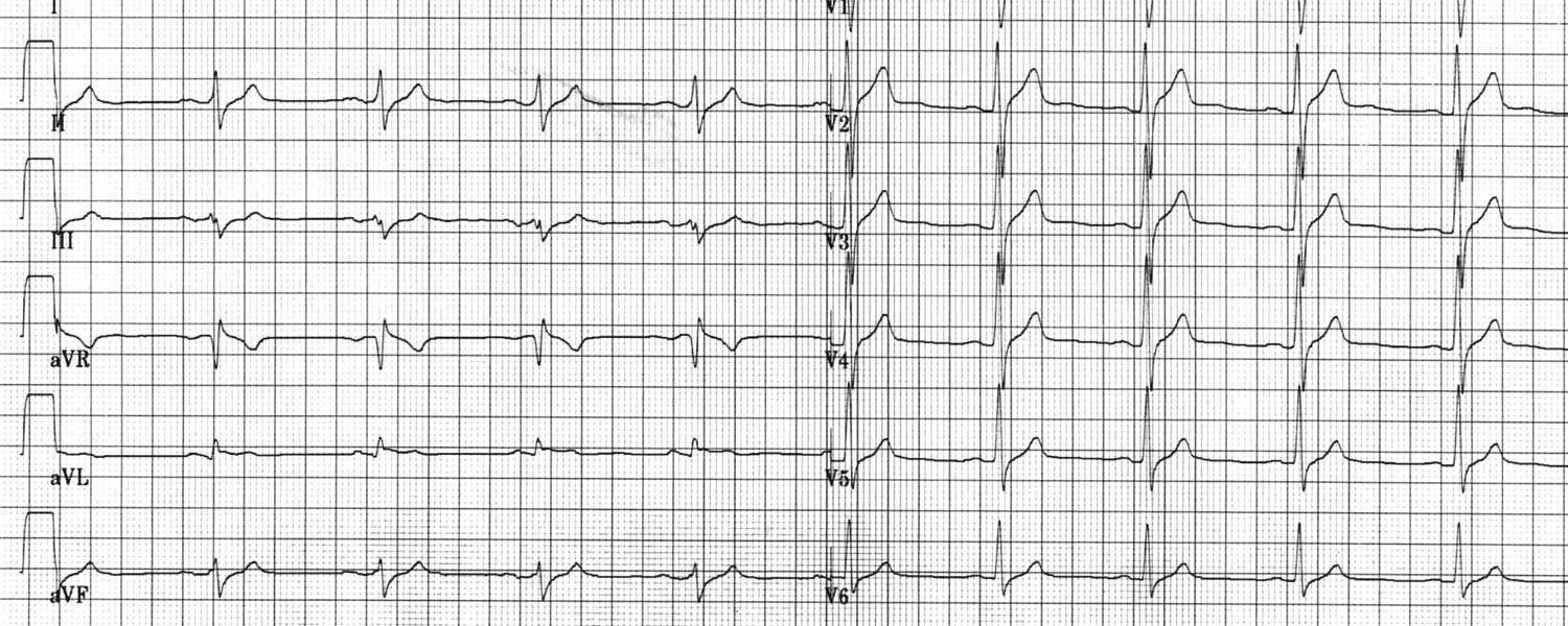 ECG bij vermoeidheidsklachten gedaan bij huisarts