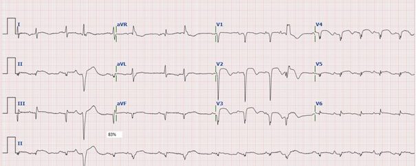 ECG: AF de novo