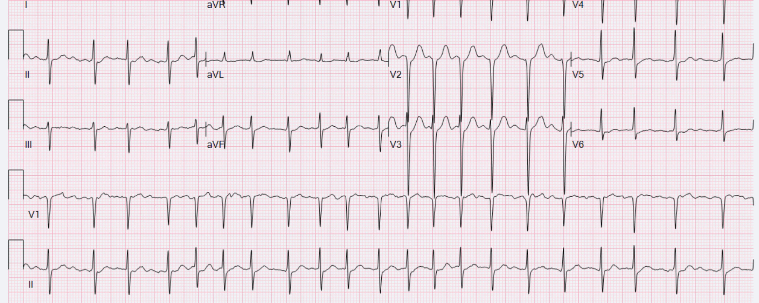 ECG