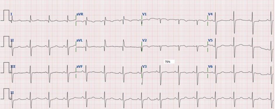 ECG Coco Smit