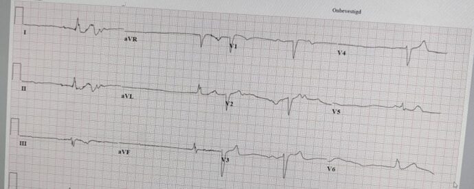 Sick sinus syndroom (bradycardie-tachycardie syndroom )