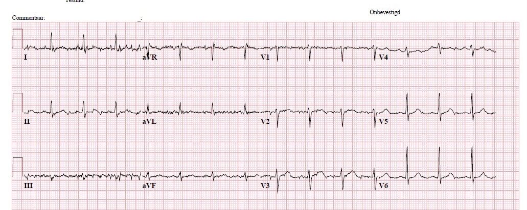Door blijvende tachycardie controle ECG