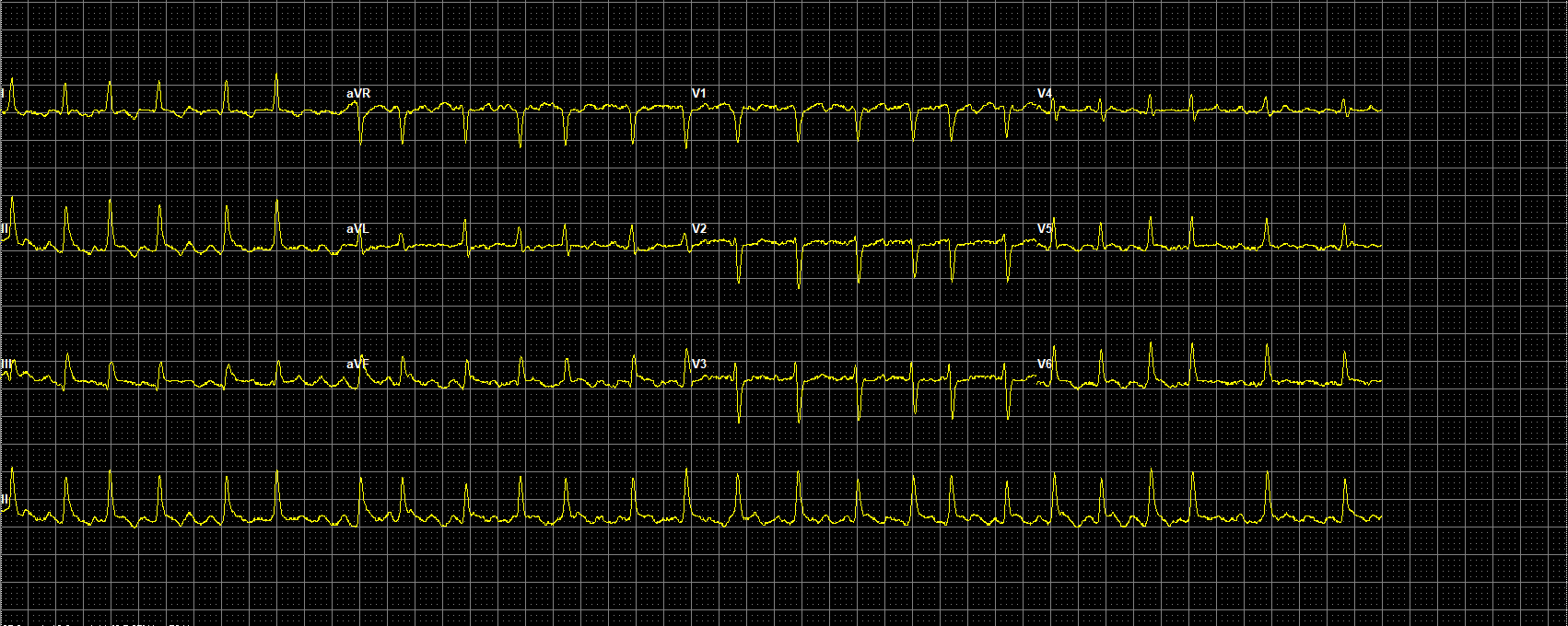 ECG opdracht TKD 1