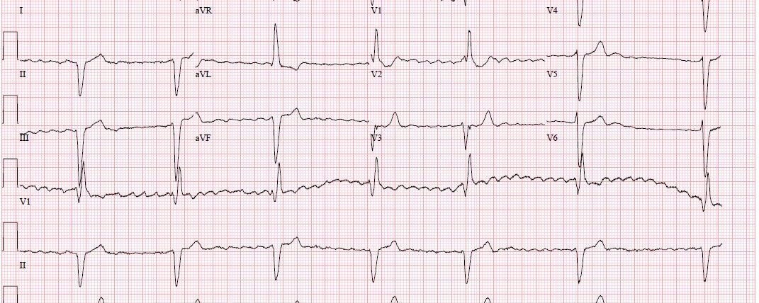 ECG