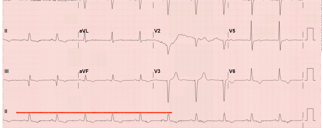 EKG Patient X