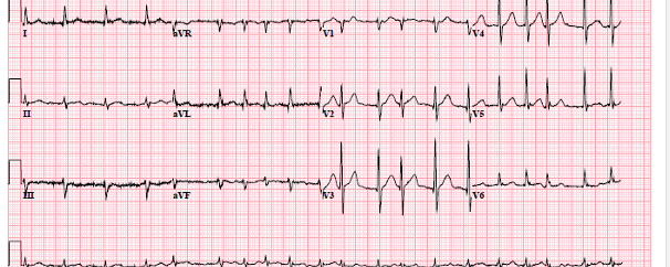 ECG bij opname SEH ivm CVA
