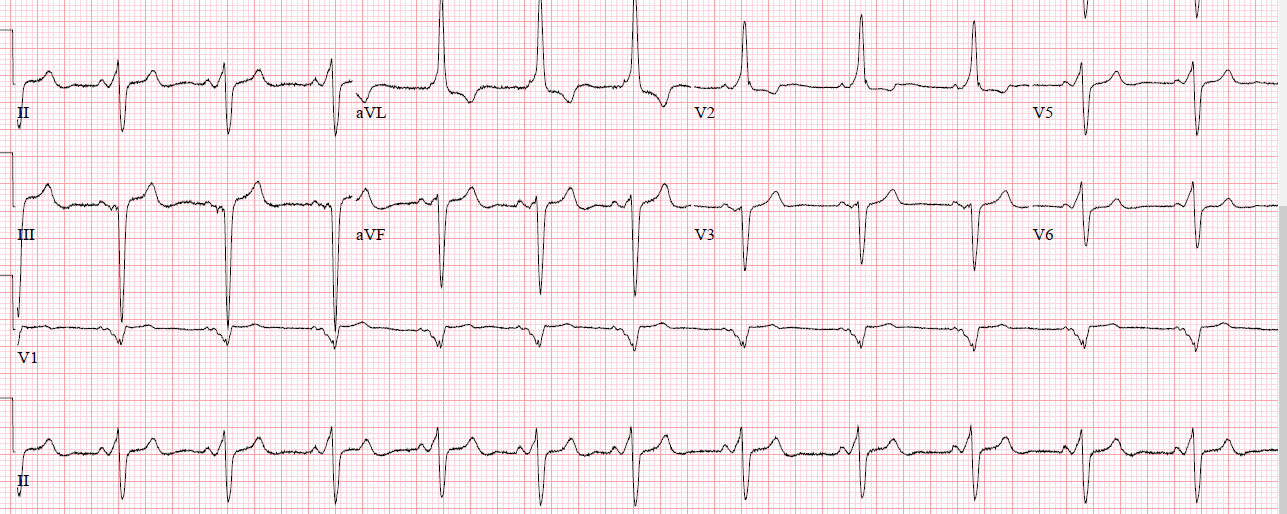 ECG catharina ZH