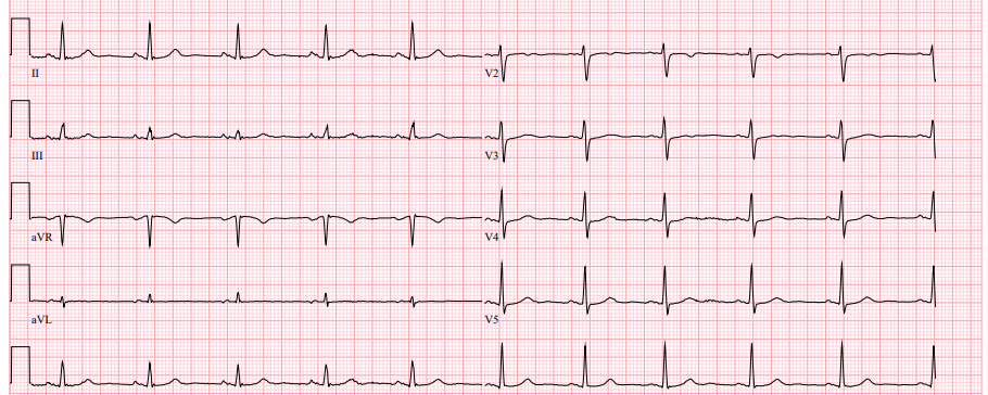 ECG van palliatief patient