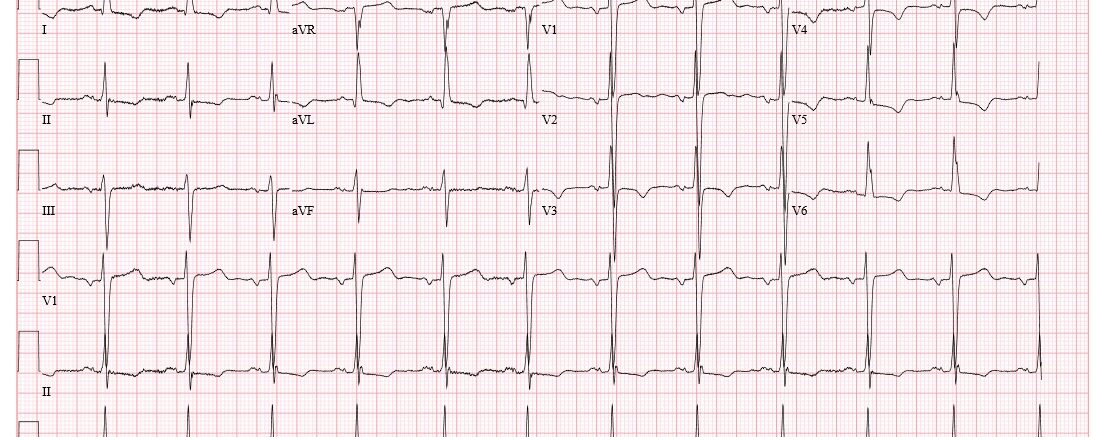 ECG opdracht F