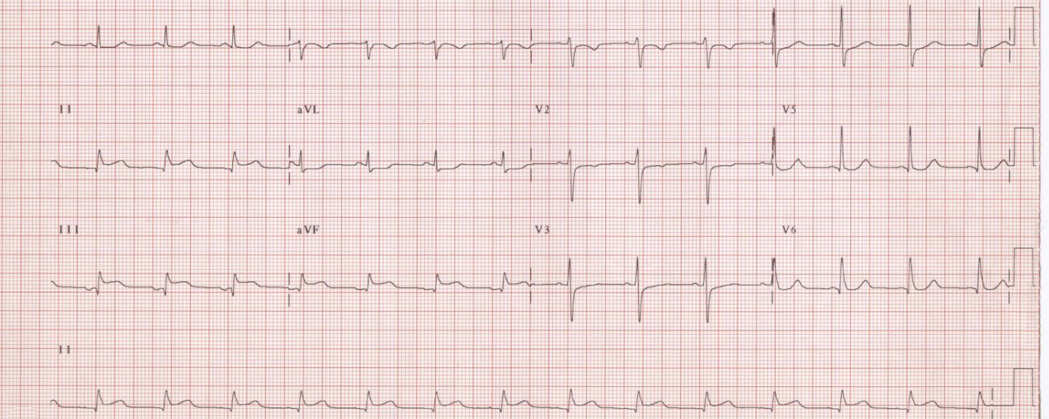 STEMI ECG