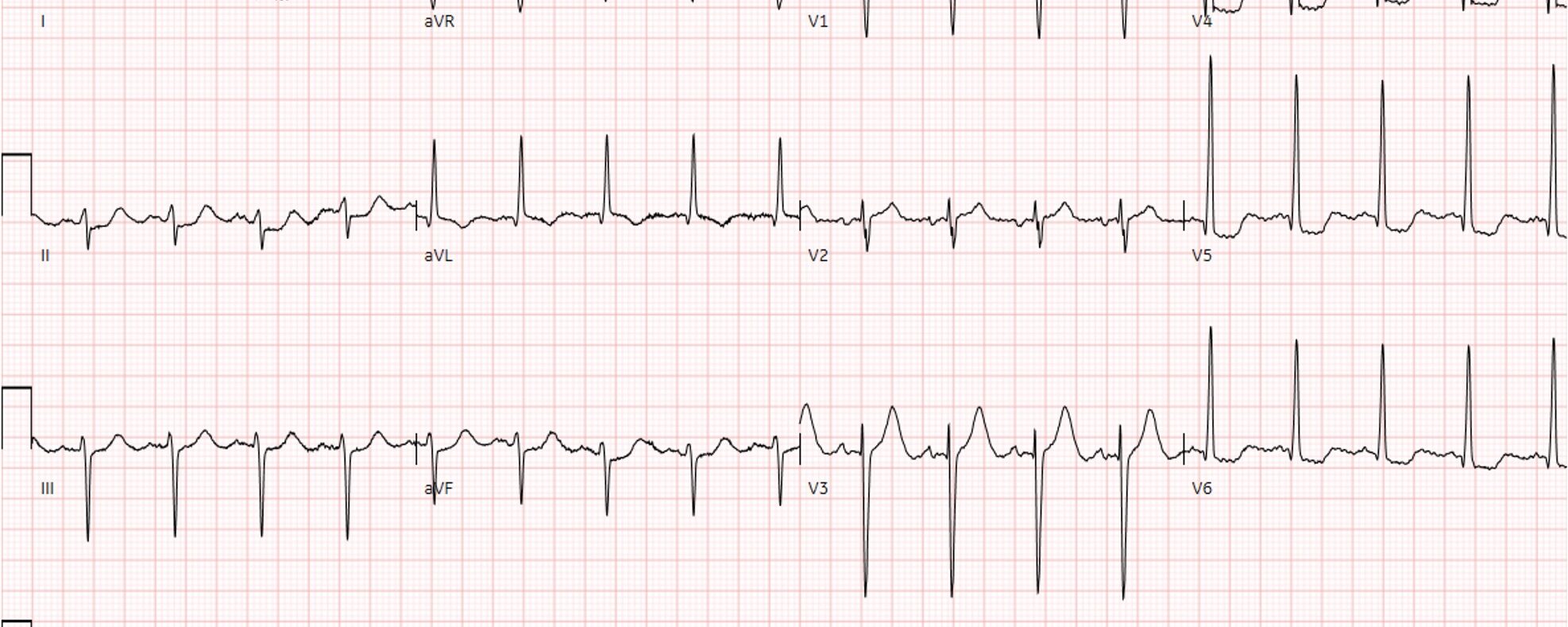 Aortaklep stenose