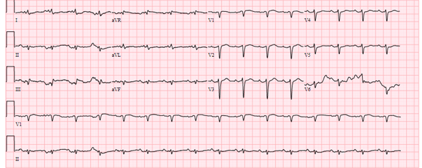 72-jarige vrouw bekend met HT, AF, DM2, verwezen naar de SEH vanwege sepsis, rillingen, hypoxemie, saturatiedaling en tachycardie.