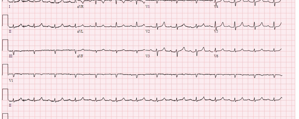 ECG 77-jarige man Interne Geneeskunde