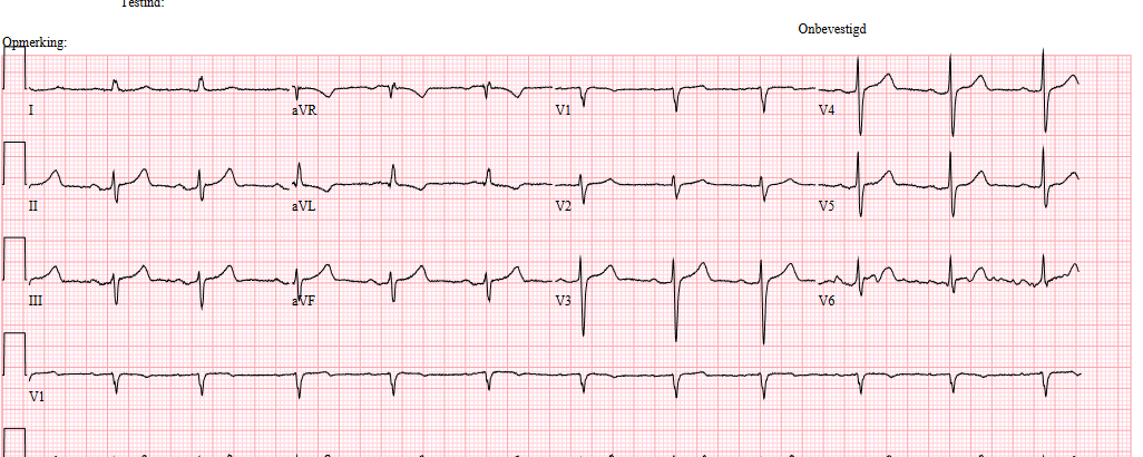 ECG – 84 jarige vrouw met desaturaties