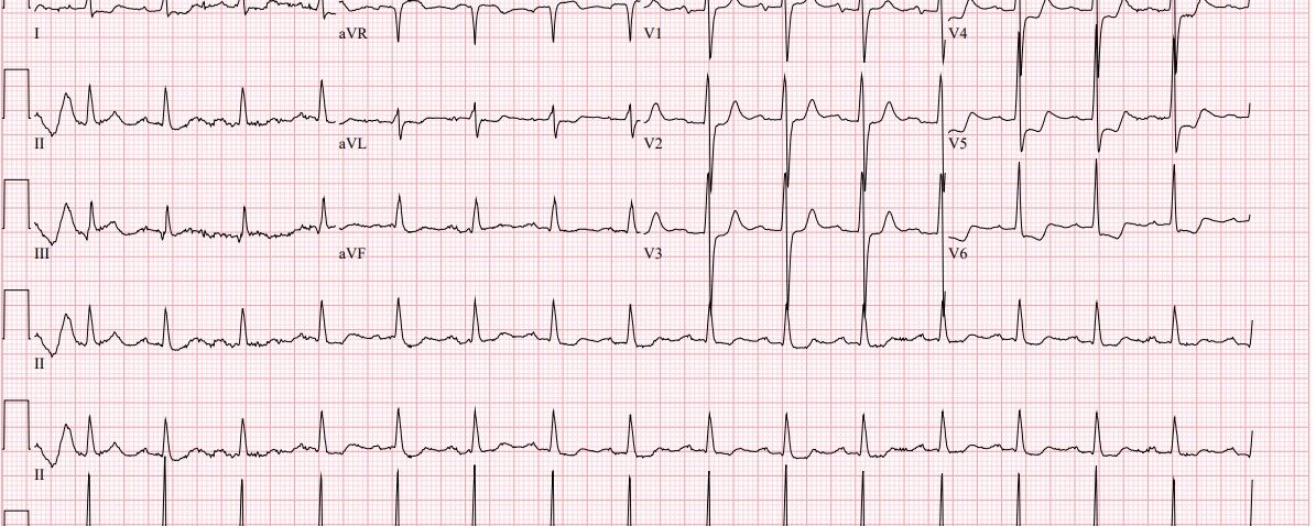 ECG mevrouw X