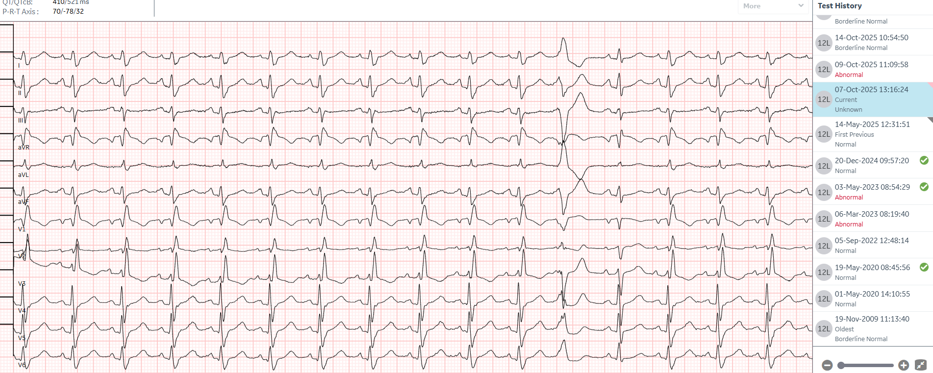 Casus: 87- jarige man met huidige onverklaarbare dyspneu na een recent ziekenhuisverblijf vanwege longontsteking, gemeld bij de SEH. Vraagstelling: Is er sprake van cardiale oorzaak voor de dyspneu? Decompensatio cordis bijvoorbeeld?