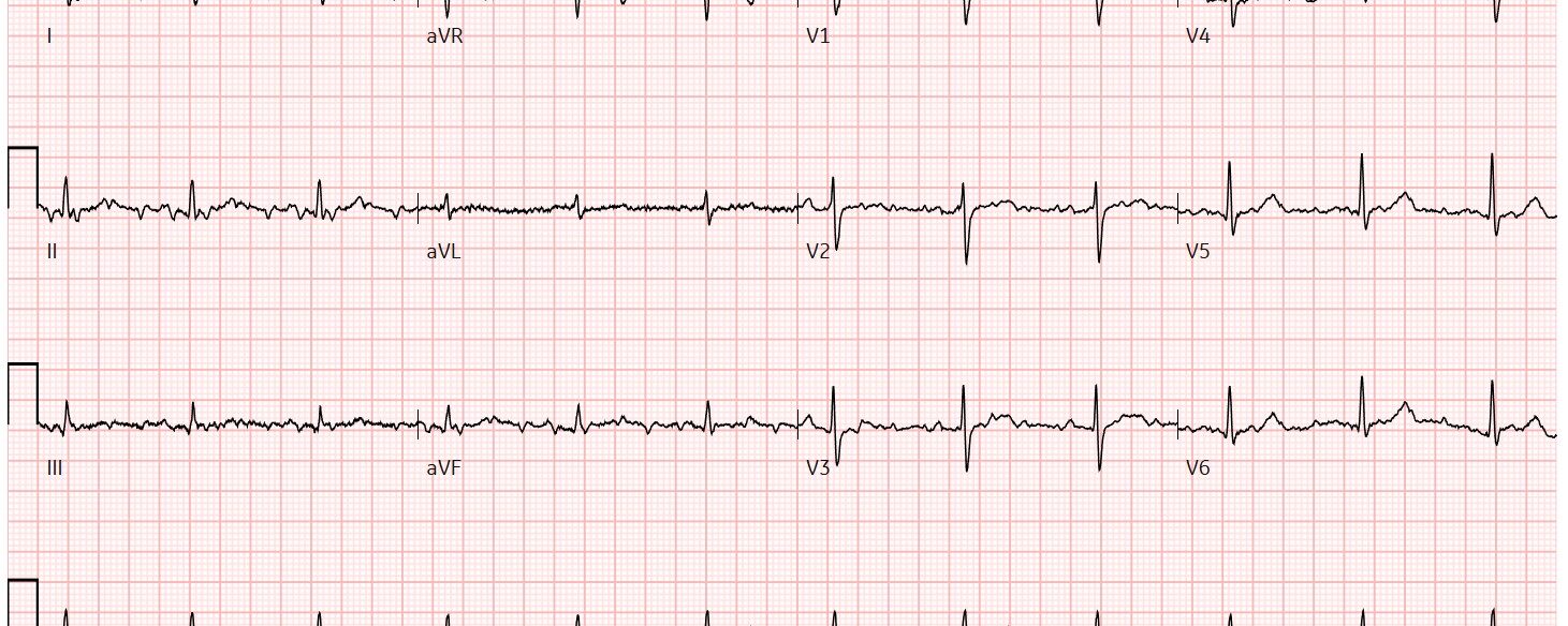 ECG opdracht