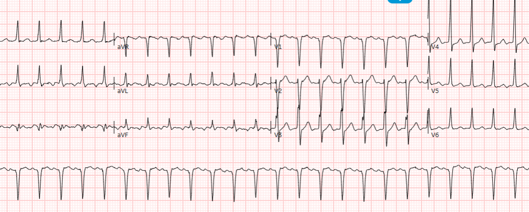 ECG Bas