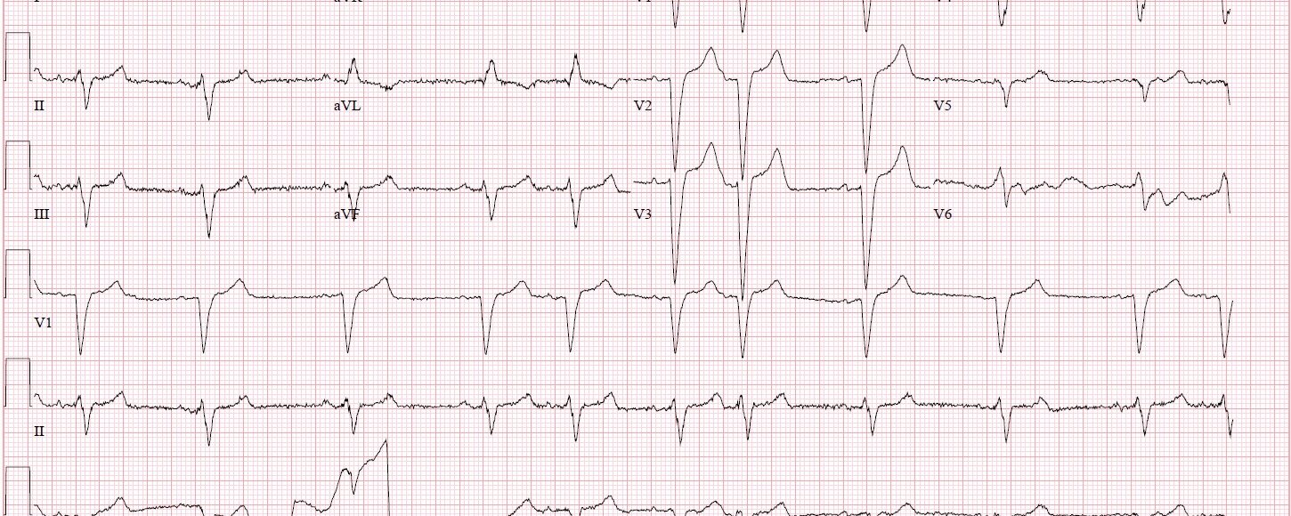 ECG