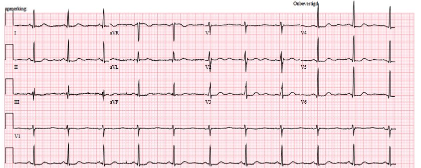 ECG bij hypokaliëmie