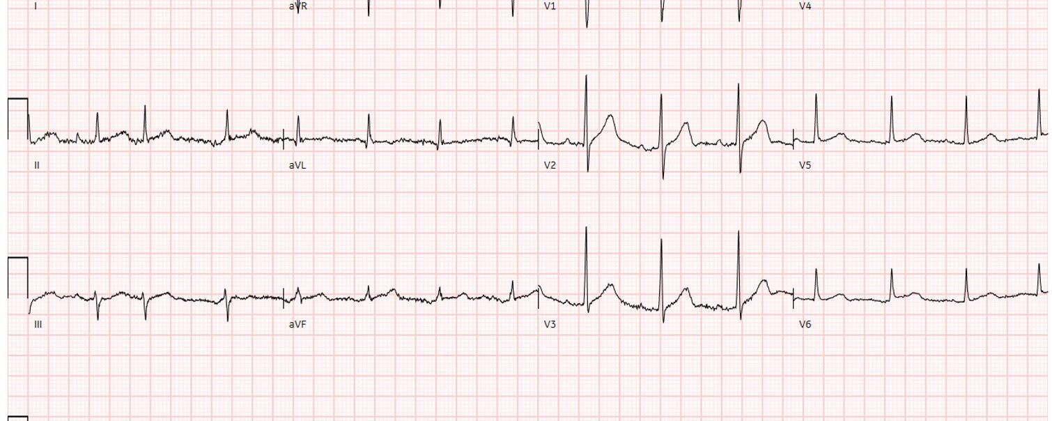 ECG