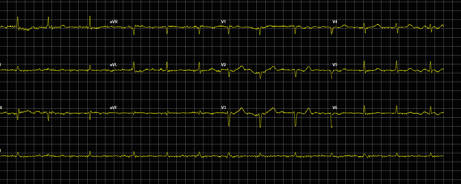 ECG Elkerliek