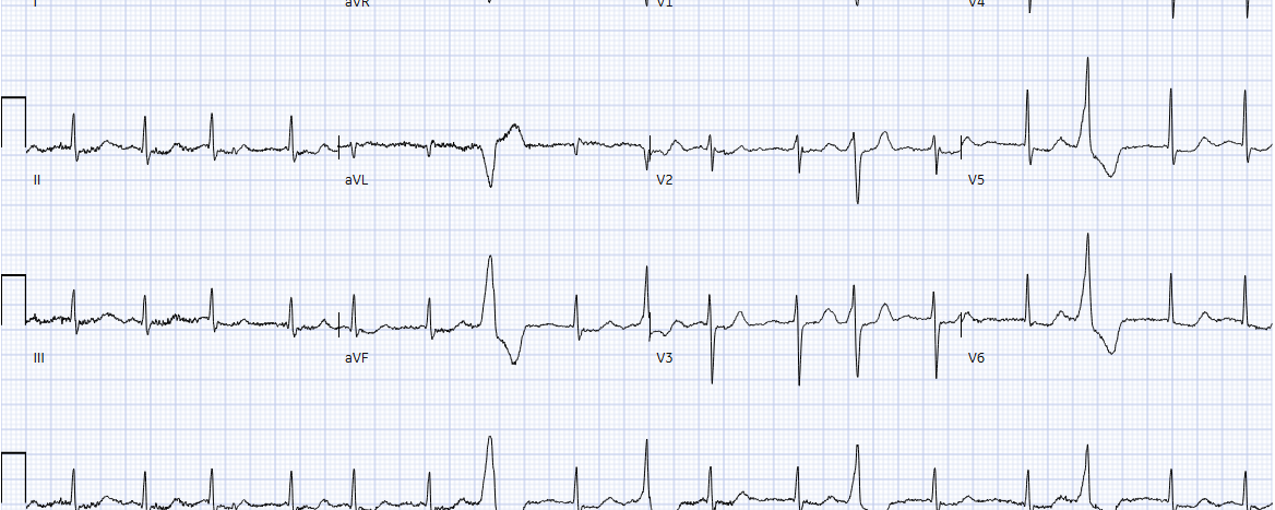 Een 88-jarige man met in de voorgeschiedenis atriumfibrilleren, perifeer arterieel vaatlijden en cerebraal infarct meldt zich op de SEH met toenemende dyspneu. Is er sprake van decompensatio cordis?