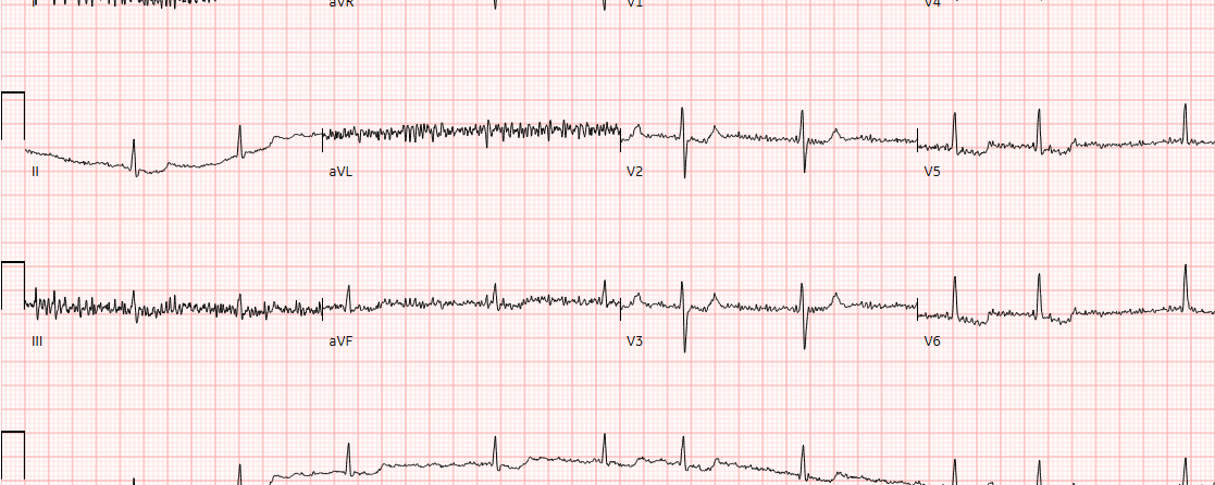 Een 88-jarige man met in de voorgeschiedenis atriumfibrilleren, perifeer arterieel vaatlijden en cerebraal infarct meldt zich op de SEH met toenemende dyspneu. Is er sprake van decompensatio cordis?
