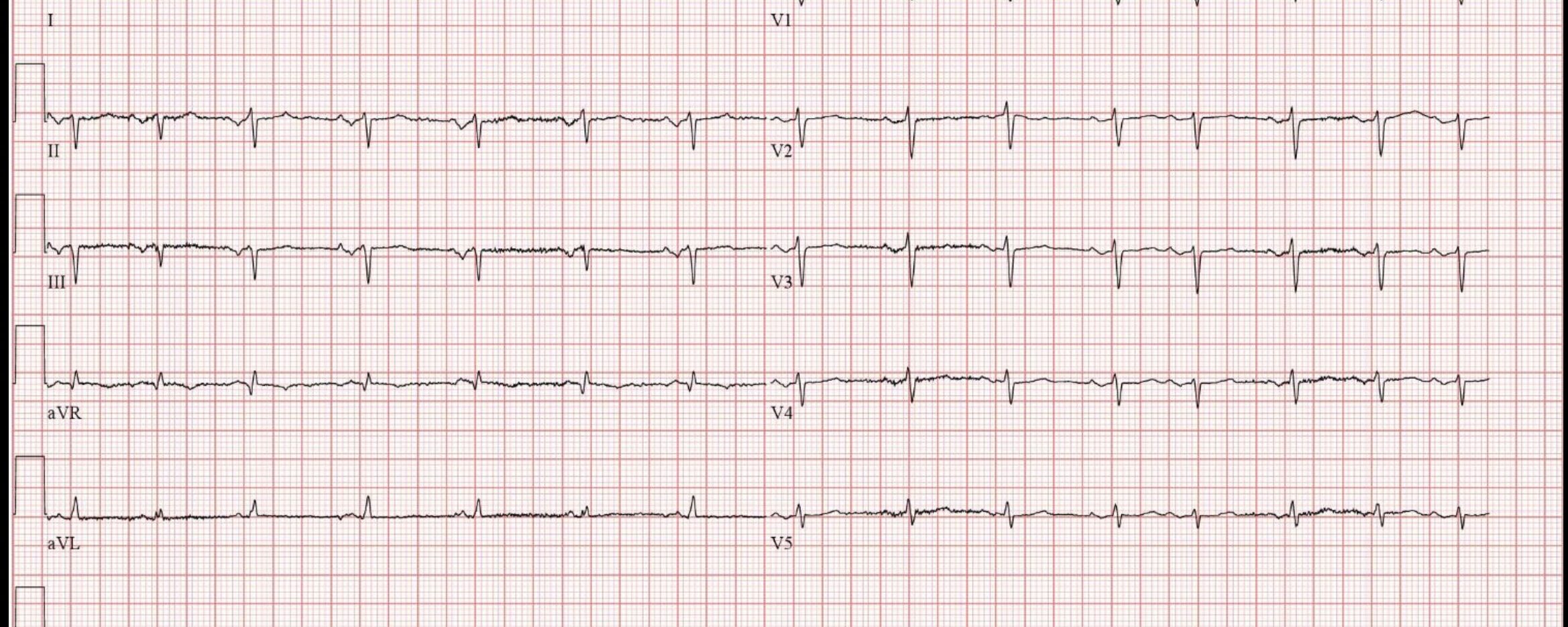ECG opdracht