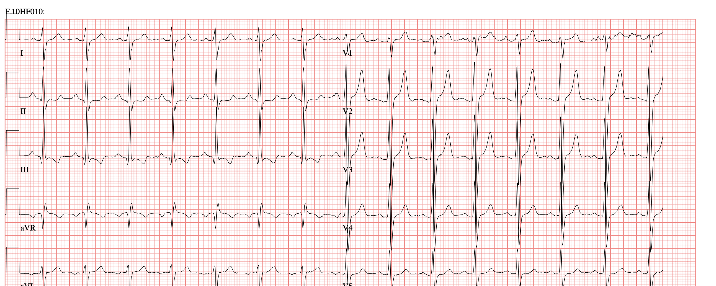 ecg hypertensie