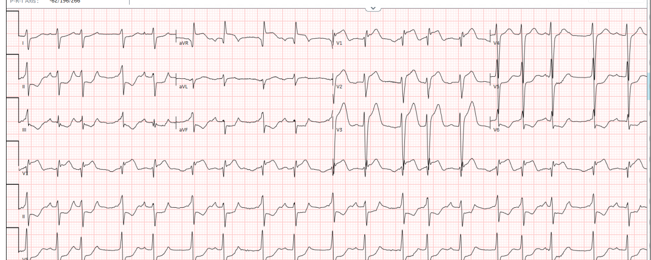 MI-infarct?